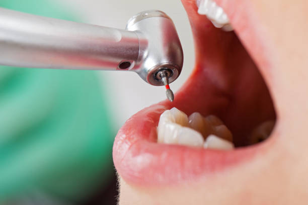 Best Emergency Dentist for Lost Fillings or Crowns in Southfield, MI